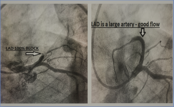 LAD RCA CTO - Kushal Cardiac Care